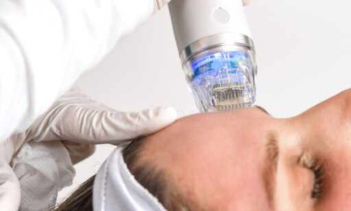 Μεσοθεραπεία Rf fractional Microneedling (μεσοθεραπεία, μικροβελονισμός και ραδιοσυχνότητες)