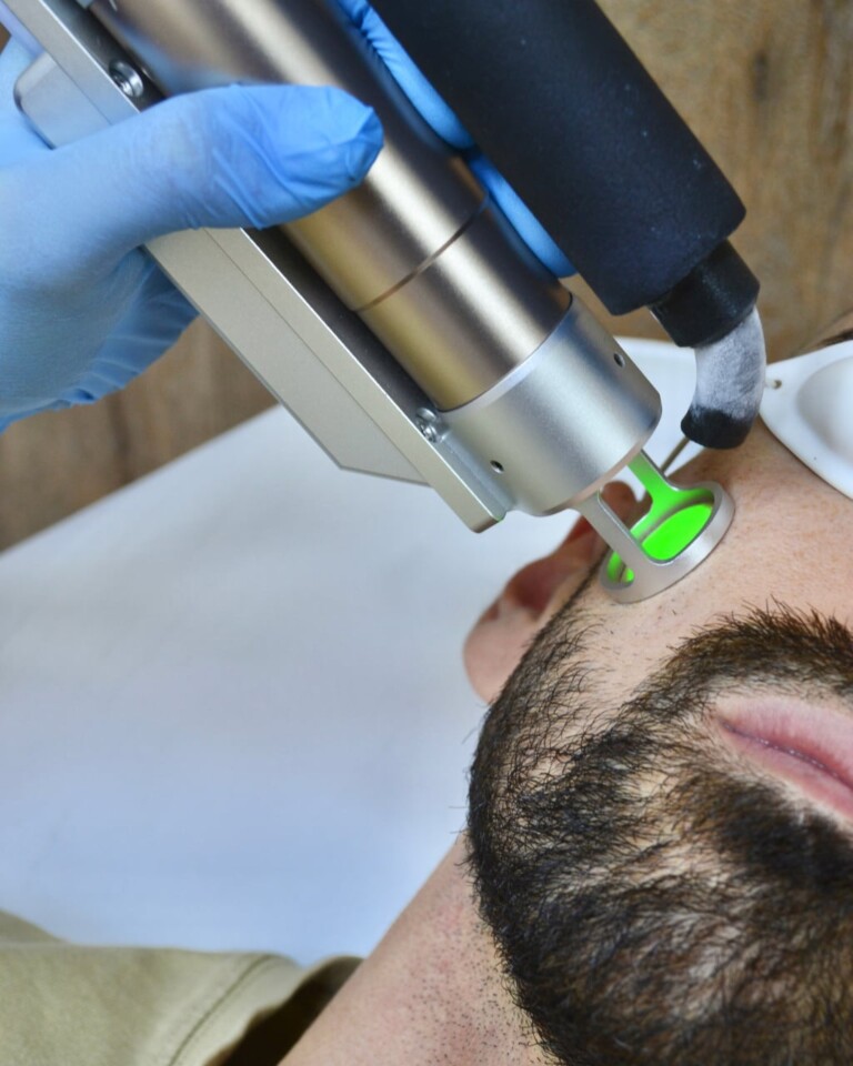 Χρήση του Laser Alexandrite σε ανδρικό πρόσωπο